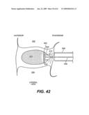 SPINAL DISC ANNULUS RECONSTRUCTION METHOD AND SPINAL DISC ANNULUS STENT diagram and image