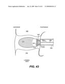 SPINAL DISC ANNULUS RECONSTRUCTION METHOD AND SPINAL DISC ANNULUS STENT diagram and image