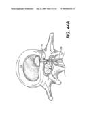 SPINAL DISC ANNULUS RECONSTRUCTION METHOD AND SPINAL DISC ANNULUS STENT diagram and image