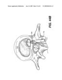 SPINAL DISC ANNULUS RECONSTRUCTION METHOD AND SPINAL DISC ANNULUS STENT diagram and image