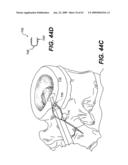 SPINAL DISC ANNULUS RECONSTRUCTION METHOD AND SPINAL DISC ANNULUS STENT diagram and image