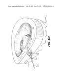 SPINAL DISC ANNULUS RECONSTRUCTION METHOD AND SPINAL DISC ANNULUS STENT diagram and image