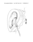 SPINAL DISC ANNULUS RECONSTRUCTION METHOD AND SPINAL DISC ANNULUS STENT diagram and image