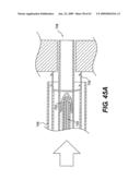 SPINAL DISC ANNULUS RECONSTRUCTION METHOD AND SPINAL DISC ANNULUS STENT diagram and image