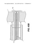 SPINAL DISC ANNULUS RECONSTRUCTION METHOD AND SPINAL DISC ANNULUS STENT diagram and image