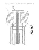 SPINAL DISC ANNULUS RECONSTRUCTION METHOD AND SPINAL DISC ANNULUS STENT diagram and image