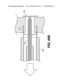 SPINAL DISC ANNULUS RECONSTRUCTION METHOD AND SPINAL DISC ANNULUS STENT diagram and image