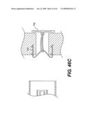 SPINAL DISC ANNULUS RECONSTRUCTION METHOD AND SPINAL DISC ANNULUS STENT diagram and image