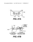 SPINAL DISC ANNULUS RECONSTRUCTION METHOD AND SPINAL DISC ANNULUS STENT diagram and image