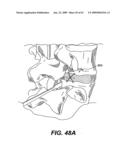 SPINAL DISC ANNULUS RECONSTRUCTION METHOD AND SPINAL DISC ANNULUS STENT diagram and image