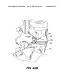 SPINAL DISC ANNULUS RECONSTRUCTION METHOD AND SPINAL DISC ANNULUS STENT diagram and image