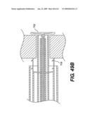 SPINAL DISC ANNULUS RECONSTRUCTION METHOD AND SPINAL DISC ANNULUS STENT diagram and image