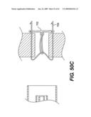 SPINAL DISC ANNULUS RECONSTRUCTION METHOD AND SPINAL DISC ANNULUS STENT diagram and image