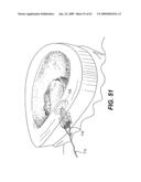 SPINAL DISC ANNULUS RECONSTRUCTION METHOD AND SPINAL DISC ANNULUS STENT diagram and image