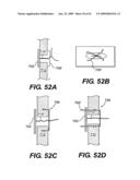 SPINAL DISC ANNULUS RECONSTRUCTION METHOD AND SPINAL DISC ANNULUS STENT diagram and image