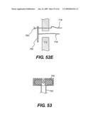 SPINAL DISC ANNULUS RECONSTRUCTION METHOD AND SPINAL DISC ANNULUS STENT diagram and image