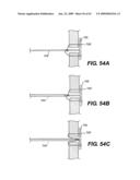 SPINAL DISC ANNULUS RECONSTRUCTION METHOD AND SPINAL DISC ANNULUS STENT diagram and image