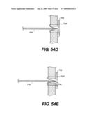 SPINAL DISC ANNULUS RECONSTRUCTION METHOD AND SPINAL DISC ANNULUS STENT diagram and image