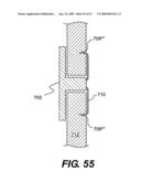 SPINAL DISC ANNULUS RECONSTRUCTION METHOD AND SPINAL DISC ANNULUS STENT diagram and image