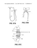 SPINAL DISC ANNULUS RECONSTRUCTION METHOD AND SPINAL DISC ANNULUS STENT diagram and image