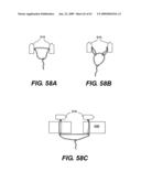 SPINAL DISC ANNULUS RECONSTRUCTION METHOD AND SPINAL DISC ANNULUS STENT diagram and image