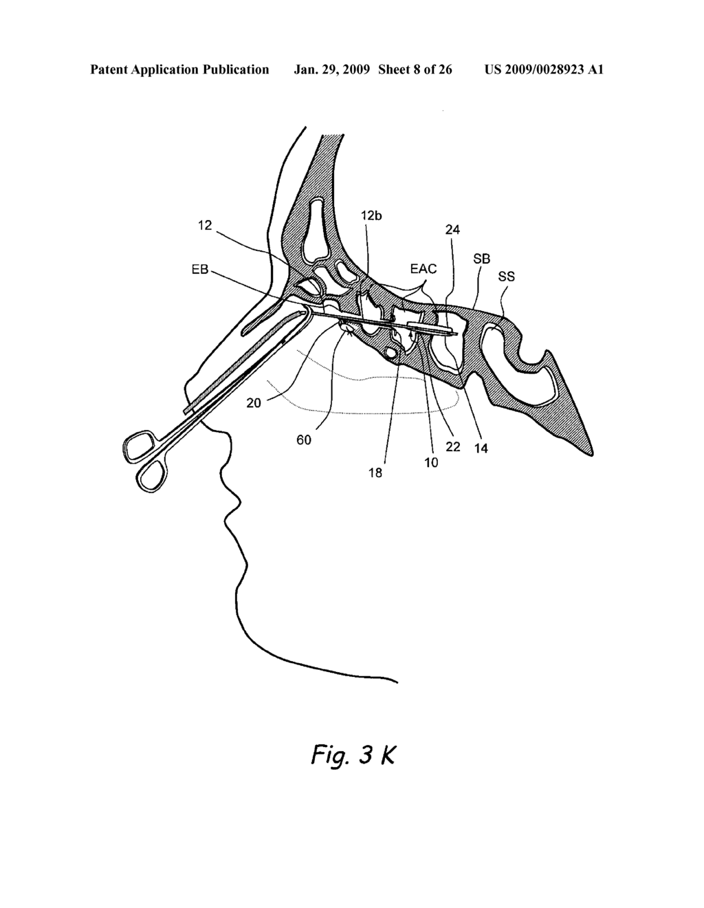 Implantable Devices and Methods for Treating Sinusitis and Other Disorders - diagram, schematic, and image 09