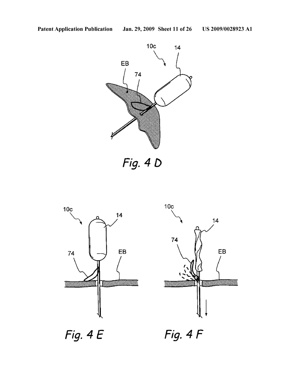 Implantable Devices and Methods for Treating Sinusitis and Other Disorders - diagram, schematic, and image 12