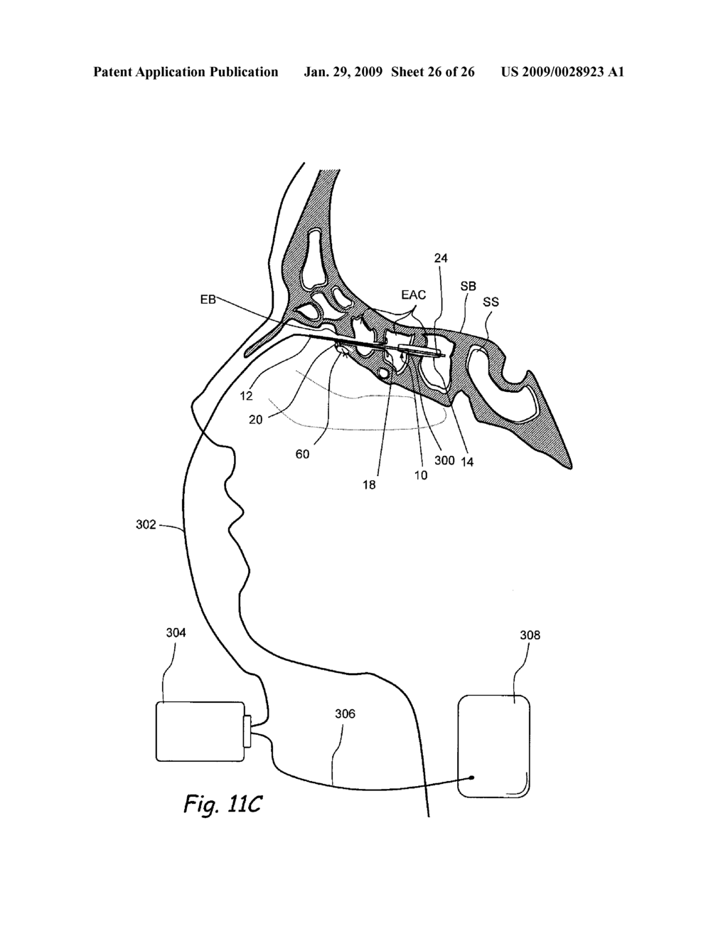 Implantable Devices and Methods for Treating Sinusitis and Other Disorders - diagram, schematic, and image 27