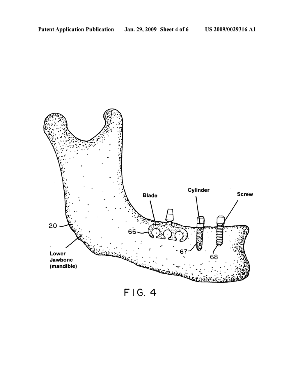 Magnetically implantable prosthetic device and method to shorten healing time, enhance bone fusion, and retard bacterial growth - diagram, schematic, and image 05