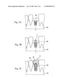 DENTAL IMPLANT AND METHOD FOR MANUFACTURING DENTAL IMPLANT diagram and image