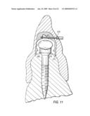 COMPONENTS FOR PERMANENT REMOVABLE AND ADJUSTABLE DENTURES AND BRIDGES diagram and image