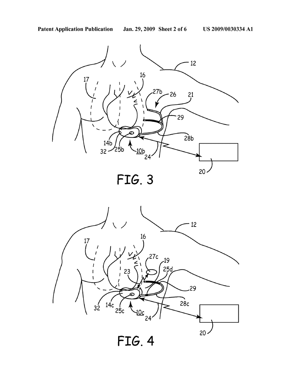 IMPLANTABLE HEART SOUND SENSOR WITH NOISE CANCELLATION - diagram, schematic, and image 03