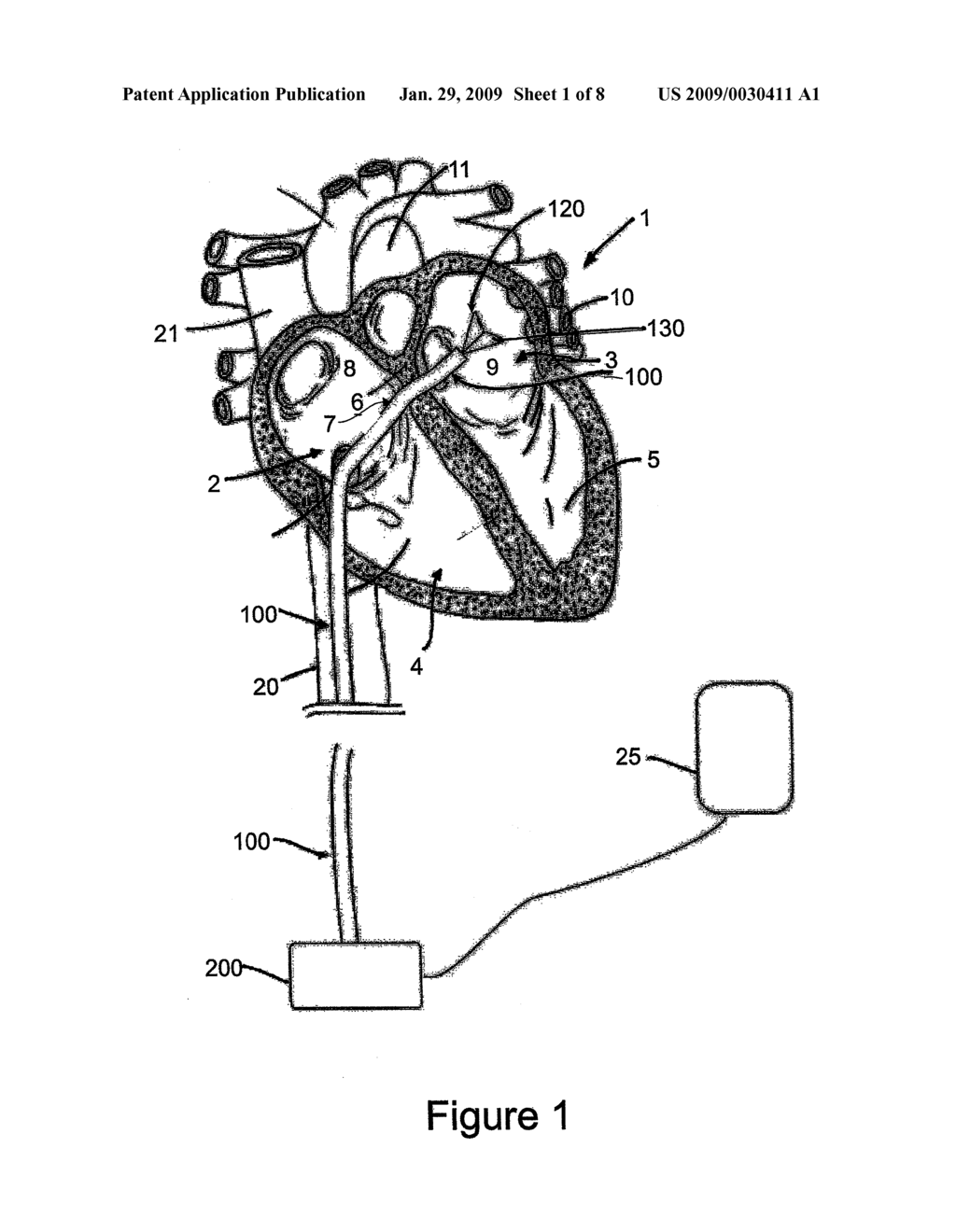 ABLATION CATHETER - diagram, schematic, and image 02