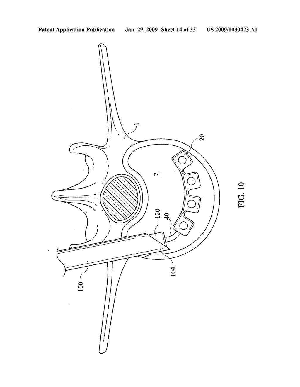 Inter-Body Implantation System and Method - diagram, schematic, and image 15