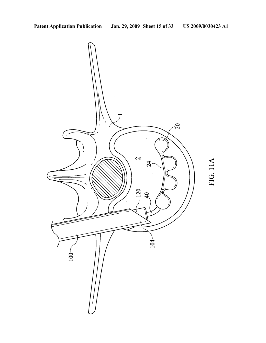 Inter-Body Implantation System and Method - diagram, schematic, and image 16