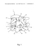 SPINAL FACET IMPLANT WITH SPHERICAL IMPLANT APPOSITION SURFACE AND BONE BED AND METHODS OF USE diagram and image