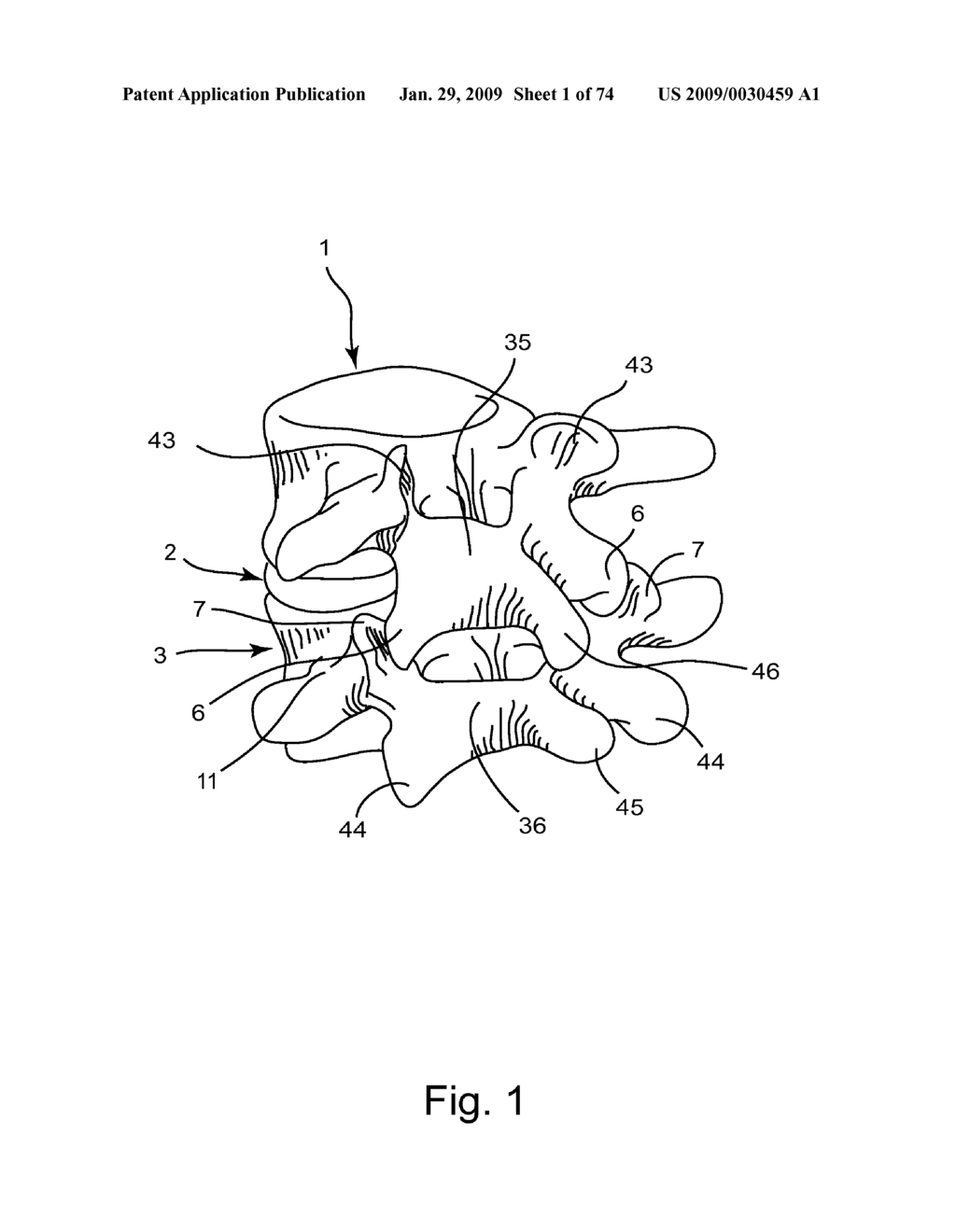 SPINAL FACET IMPLANT WITH SPHERICAL IMPLANT APPOSITION SURFACE AND BONE BED AND METHODS OF USE - diagram, schematic, and image 02