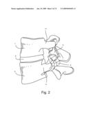 SPINAL FACET IMPLANT WITH SPHERICAL IMPLANT APPOSITION SURFACE AND BONE BED AND METHODS OF USE diagram and image