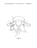 SPINAL FACET IMPLANT WITH SPHERICAL IMPLANT APPOSITION SURFACE AND BONE BED AND METHODS OF USE diagram and image