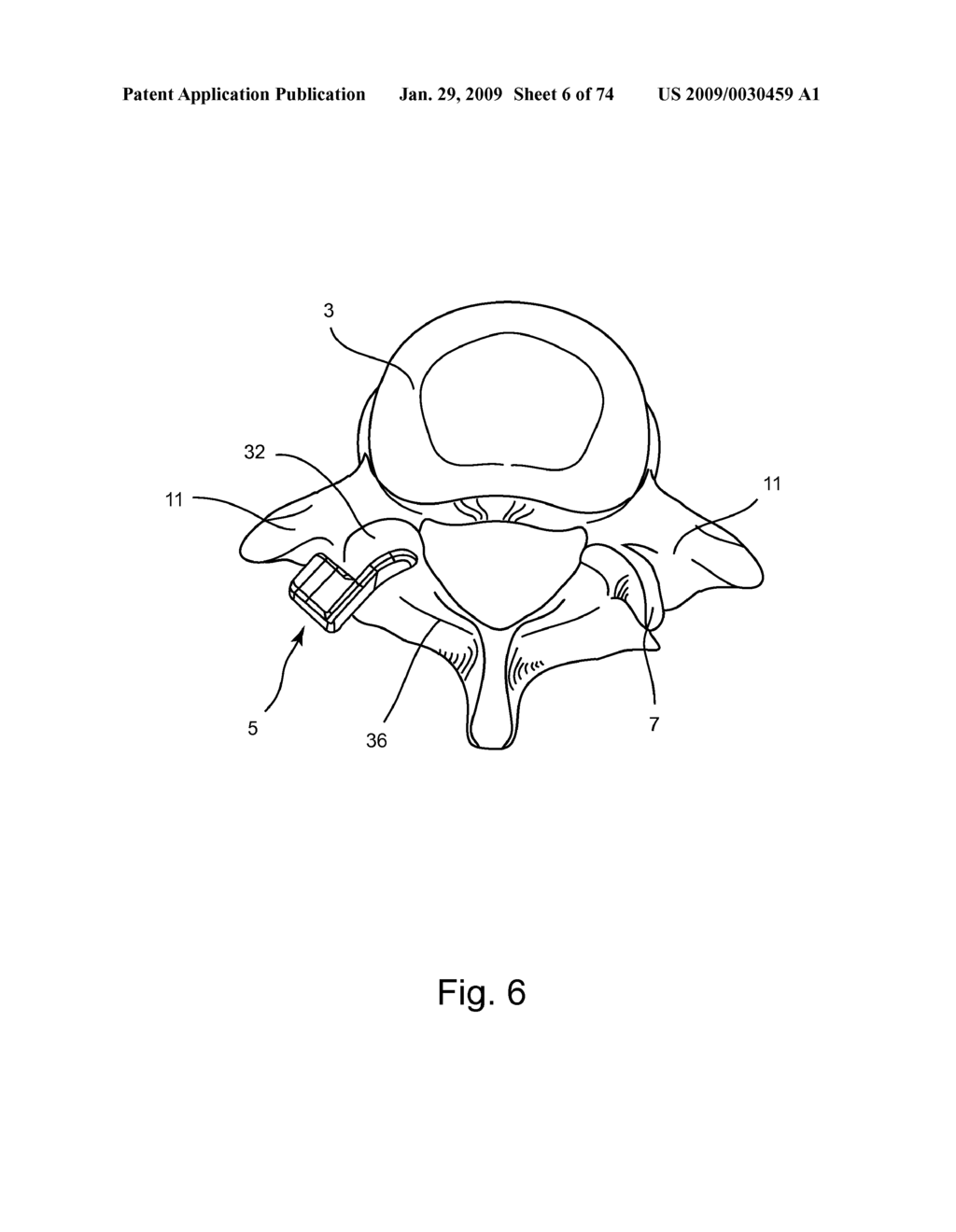 SPINAL FACET IMPLANT WITH SPHERICAL IMPLANT APPOSITION SURFACE AND BONE BED AND METHODS OF USE - diagram, schematic, and image 07