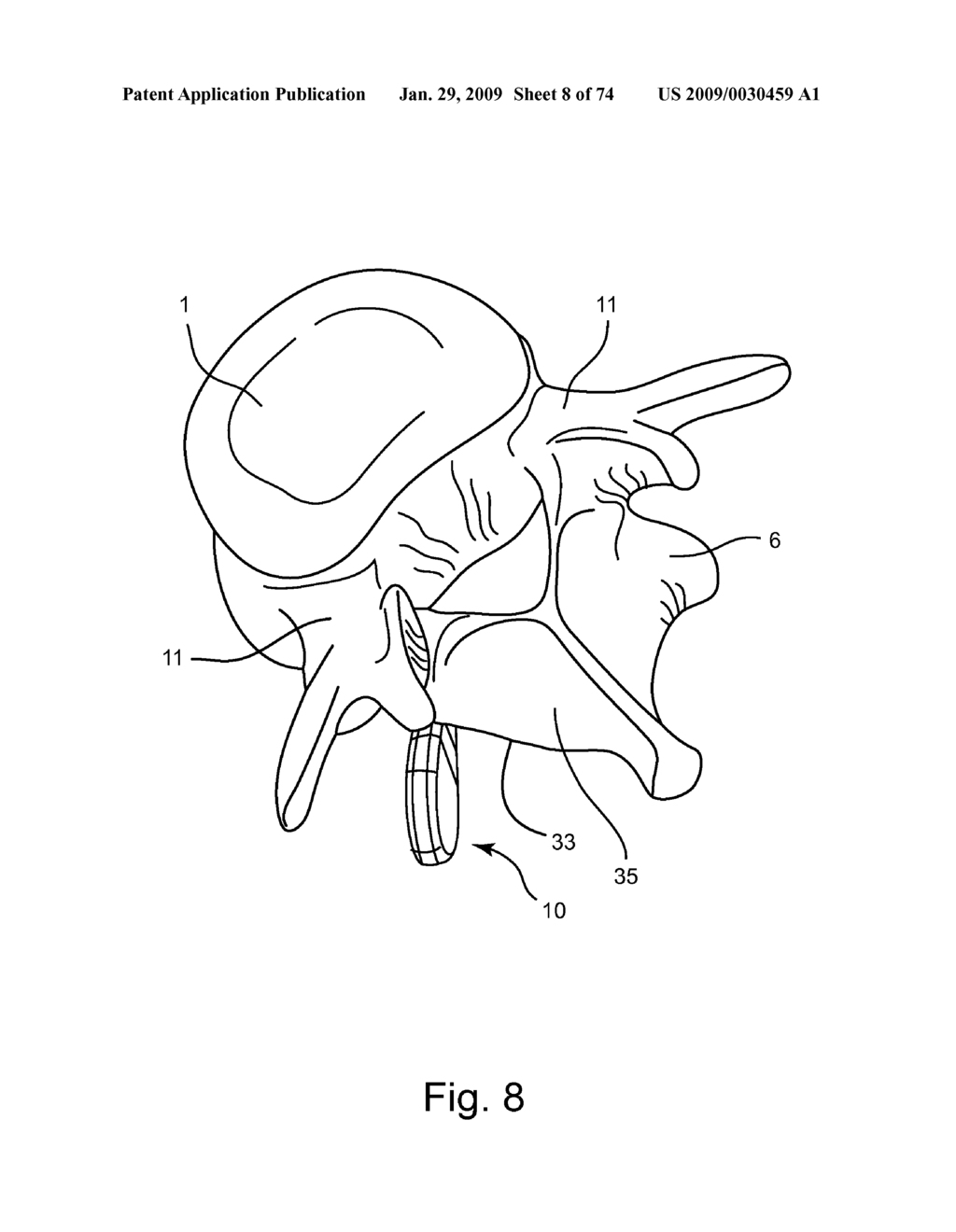 SPINAL FACET IMPLANT WITH SPHERICAL IMPLANT APPOSITION SURFACE AND BONE BED AND METHODS OF USE - diagram, schematic, and image 09