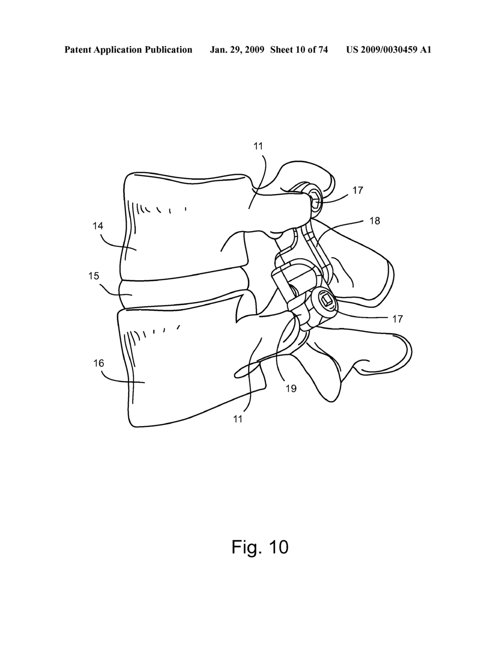 SPINAL FACET IMPLANT WITH SPHERICAL IMPLANT APPOSITION SURFACE AND BONE BED AND METHODS OF USE - diagram, schematic, and image 11