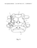 SPINAL FACET IMPLANT WITH SPHERICAL IMPLANT APPOSITION SURFACE AND BONE BED AND METHODS OF USE diagram and image