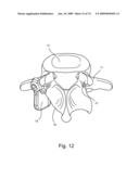 SPINAL FACET IMPLANT WITH SPHERICAL IMPLANT APPOSITION SURFACE AND BONE BED AND METHODS OF USE diagram and image