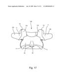 SPINAL FACET IMPLANT WITH SPHERICAL IMPLANT APPOSITION SURFACE AND BONE BED AND METHODS OF USE diagram and image