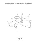 SPINAL FACET IMPLANT WITH SPHERICAL IMPLANT APPOSITION SURFACE AND BONE BED AND METHODS OF USE diagram and image