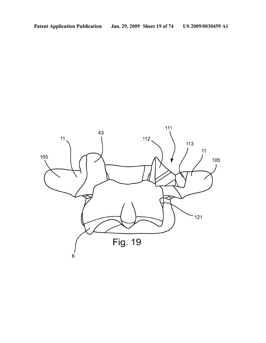 SPINAL FACET IMPLANT WITH SPHERICAL IMPLANT APPOSITION SURFACE AND BONE BED AND METHODS OF USE - diagram, schematic, and image 20