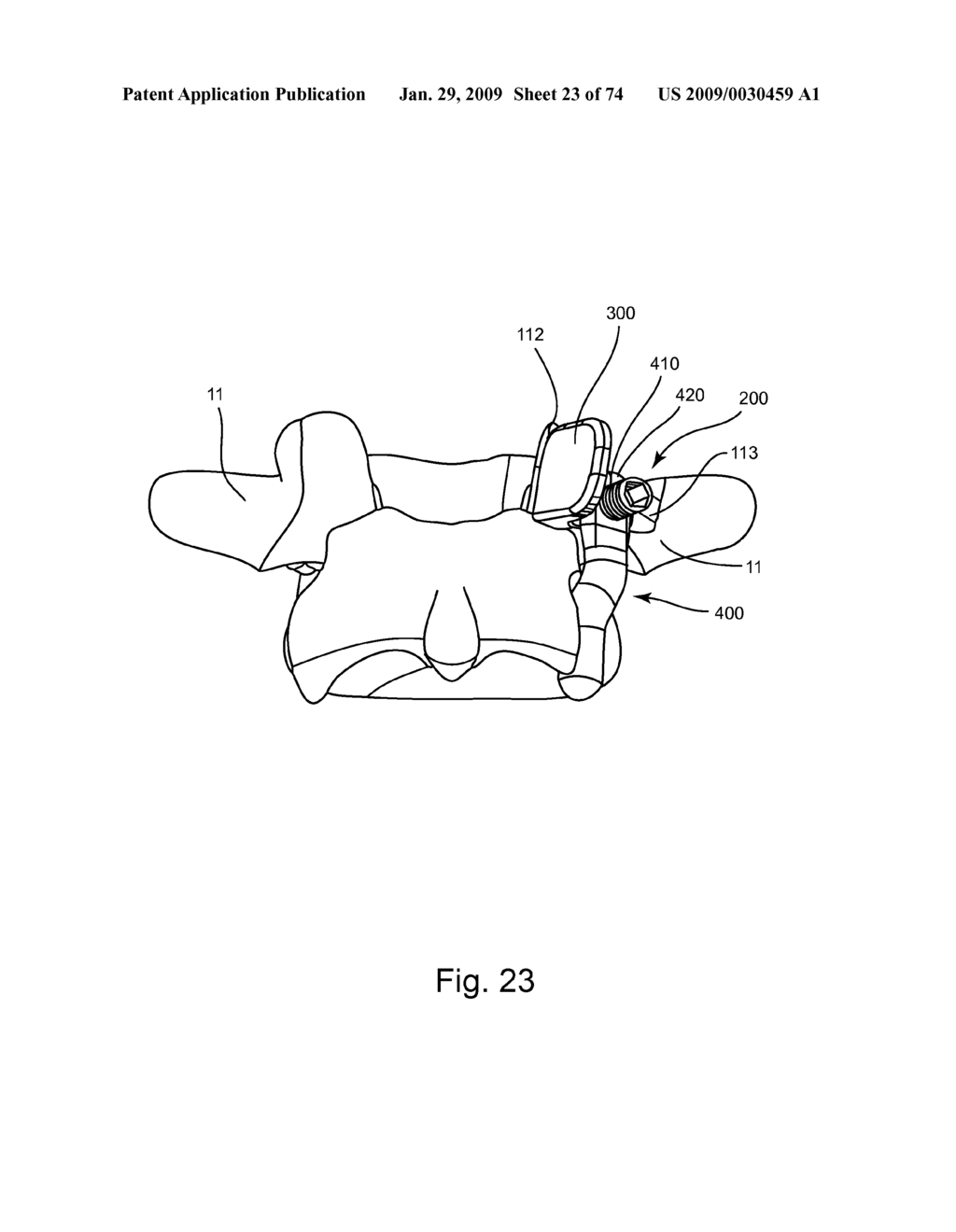 SPINAL FACET IMPLANT WITH SPHERICAL IMPLANT APPOSITION SURFACE AND BONE BED AND METHODS OF USE - diagram, schematic, and image 24