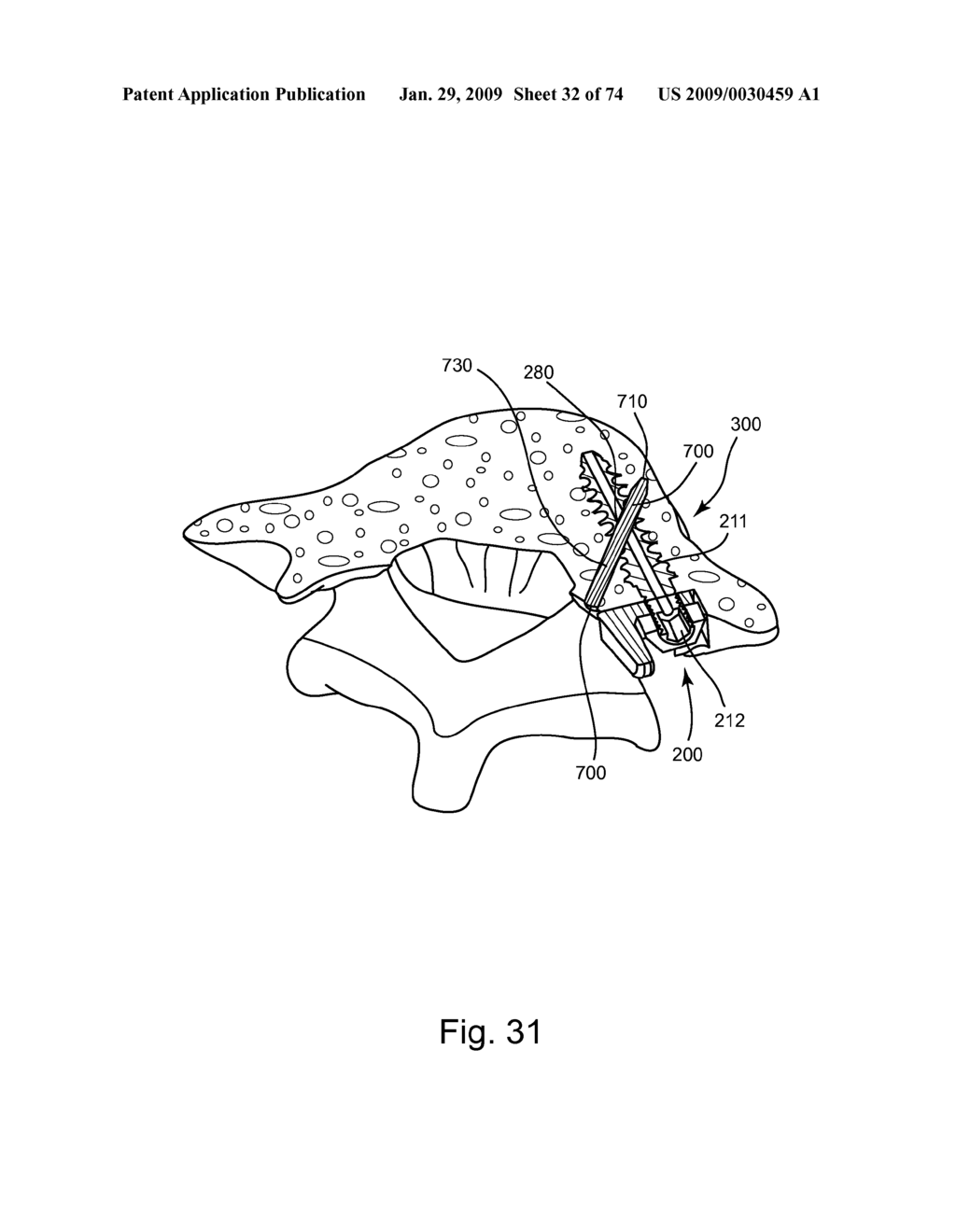 SPINAL FACET IMPLANT WITH SPHERICAL IMPLANT APPOSITION SURFACE AND BONE BED AND METHODS OF USE - diagram, schematic, and image 33