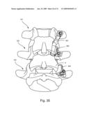 SPINAL FACET IMPLANT WITH SPHERICAL IMPLANT APPOSITION SURFACE AND BONE BED AND METHODS OF USE diagram and image